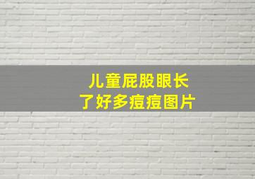 儿童屁股眼长了好多痘痘图片